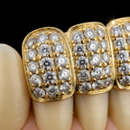Custom Gold, Silver & Diamond Grillz